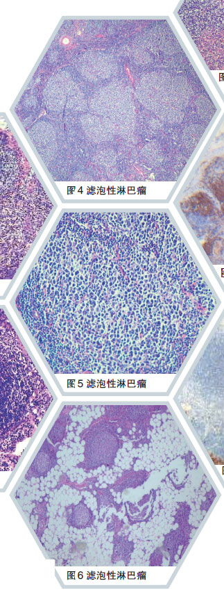 排列并不拥挤,滤泡大小不一,可见淋巴结的被膜下窦及髓窦,各种滤泡均