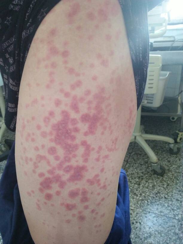 博莱霉素罕见过敏皮疹～多形红斑