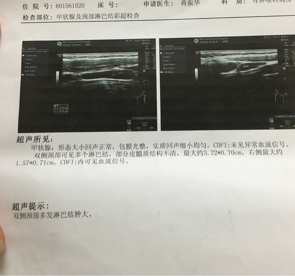 大家脖子上淋巴结多大有没有接近4厘米的穿刺后淋巴结变多变大更恐慌