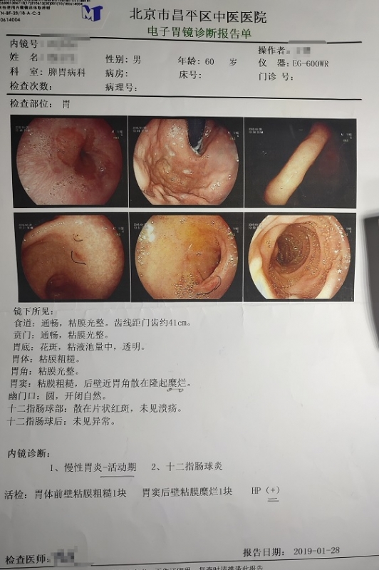 胃淋巴瘤胃镜图片