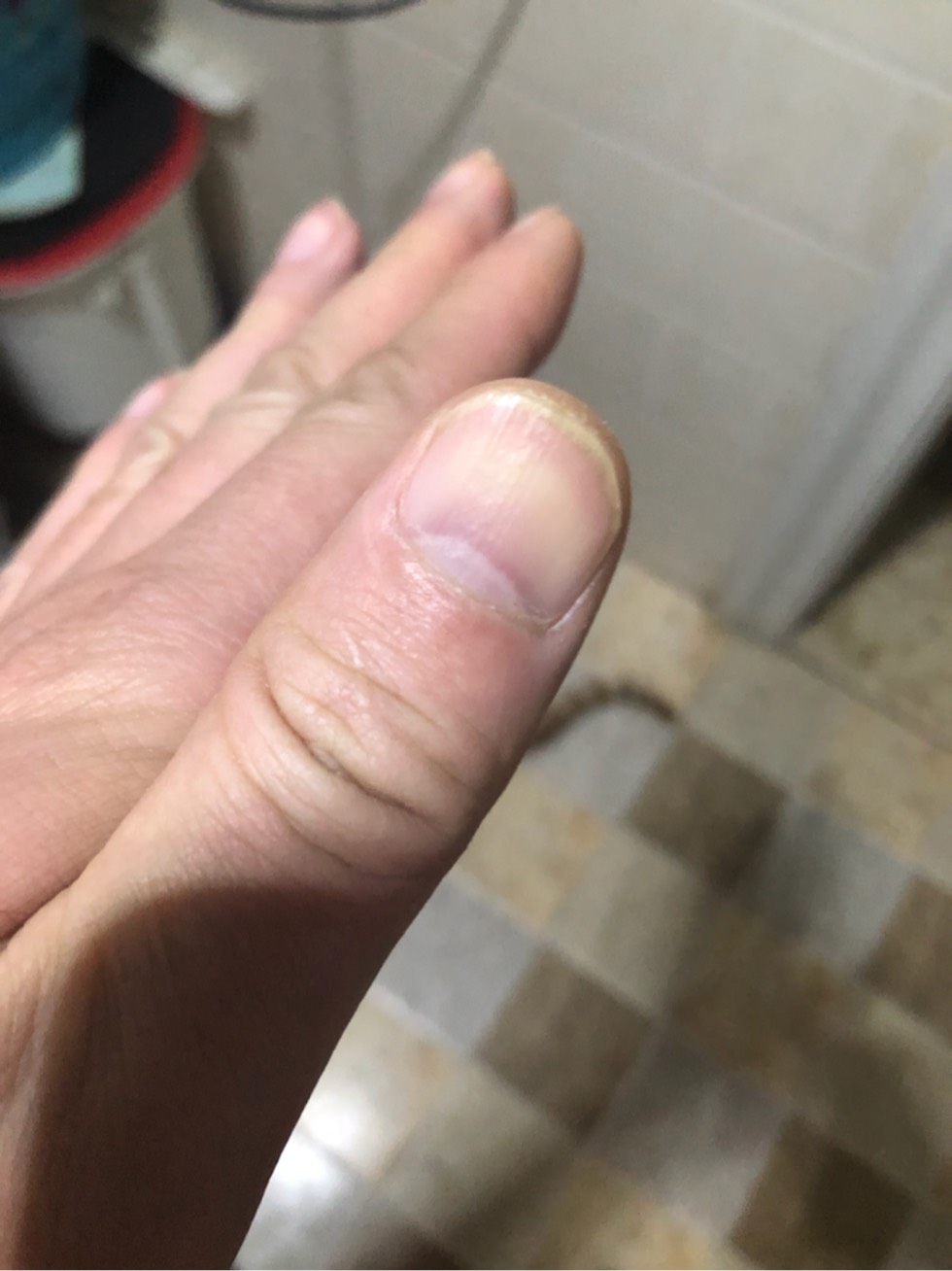 结疗9个多月今天早晨发现平时正常的指甲变紫