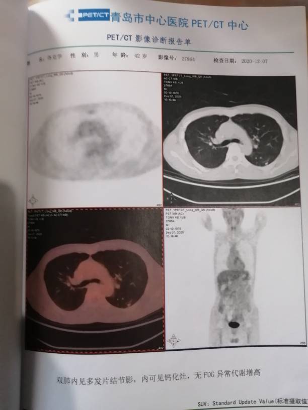 四疗后的派特ct结果