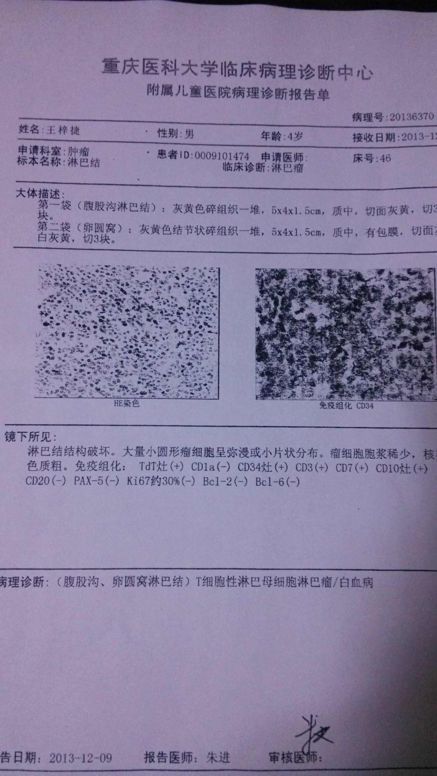 淋巴瘤图片 病理报告图片