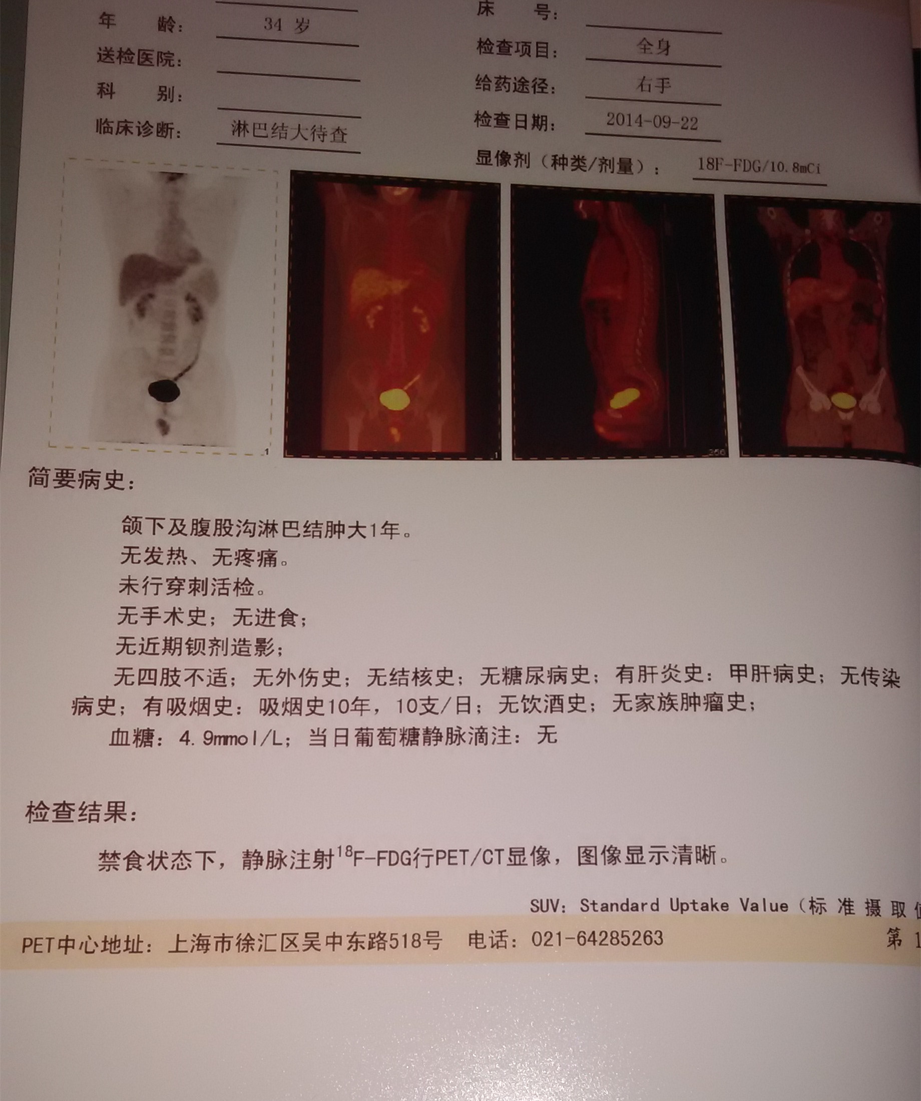 全身淋巴结肿大一年做了petct还有个问题请教