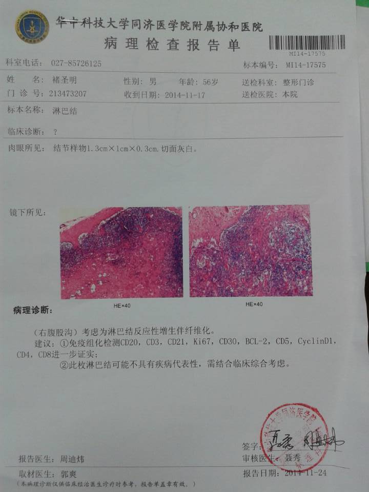 腹股沟淋巴结活检