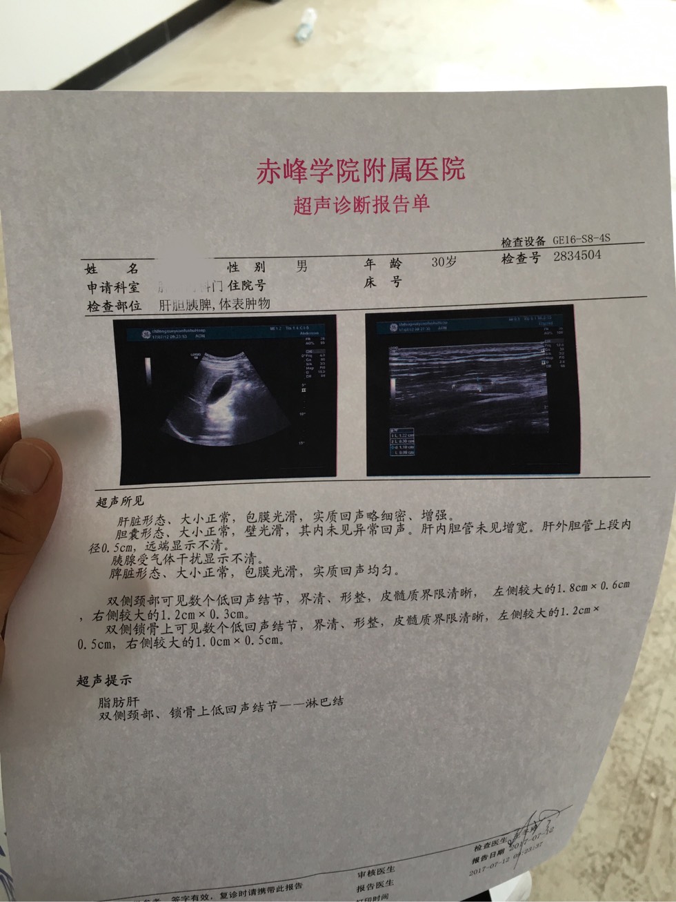 淋巴結長大了 並且頸部淋巴結腫大很深都摸不到