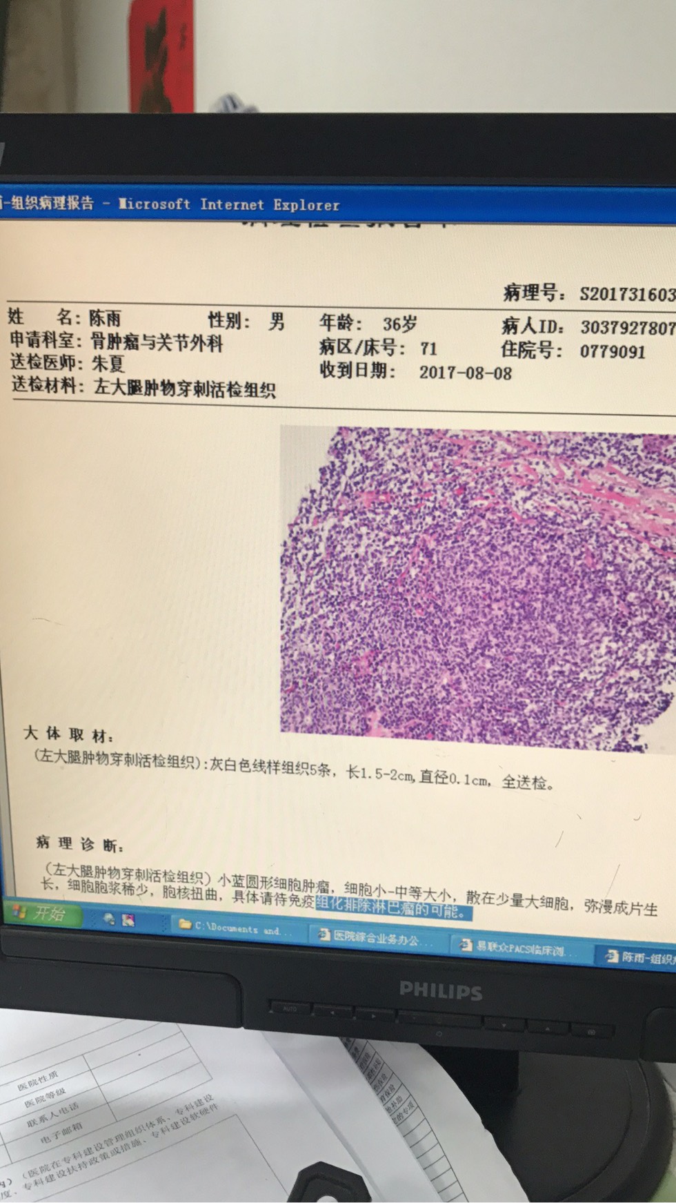 穿刺活检:小蓝圆形细胞肿瘤,是什么意思