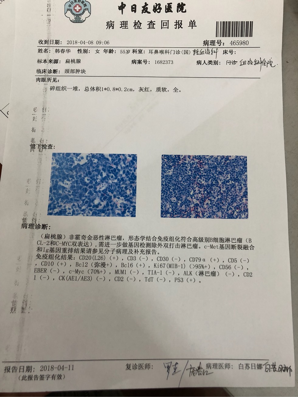 求大家帮忙看看差骨髓穿刺结果这个很严重么ki67大于95