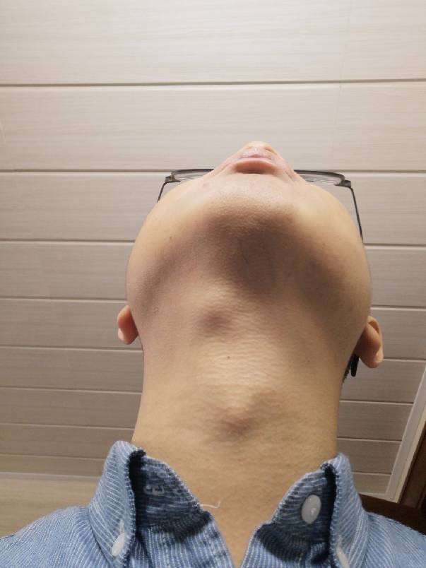 脖子淋巴瘤早期症状图片