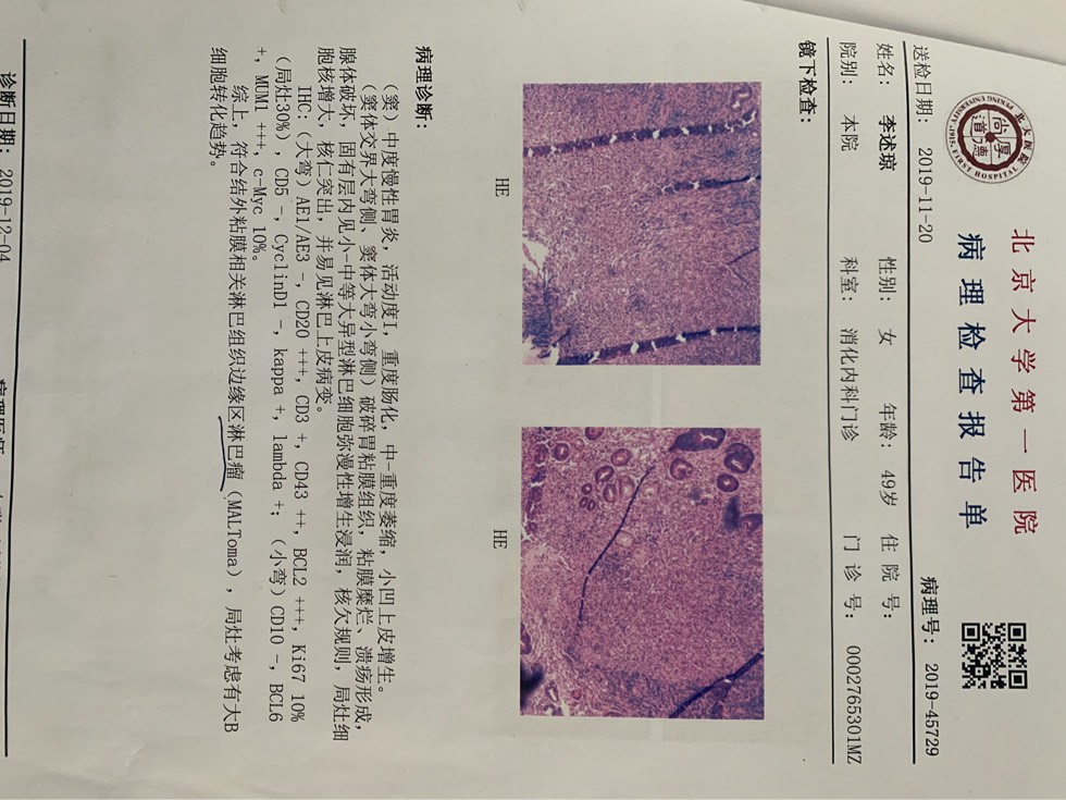 请问胃malt淋巴瘤有采用r2治疗方案的吗