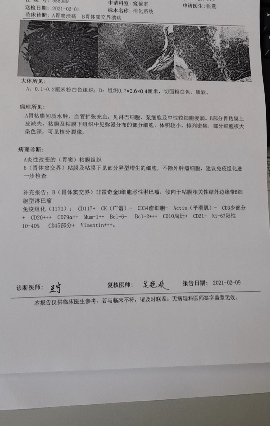 胃体窦发现非霍奇金淋巴瘤倾向于粘膜相关性结节外边缘带b细胞淋巴瘤