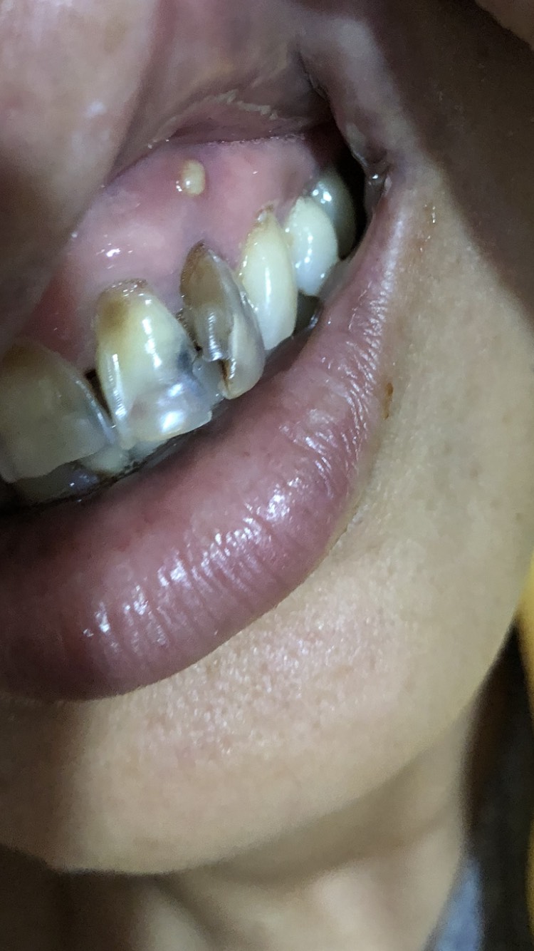 慢性牙槽脓肿图片
