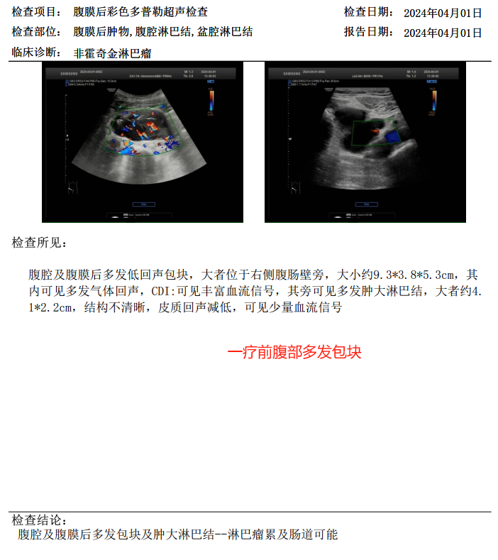 腹腔彩超