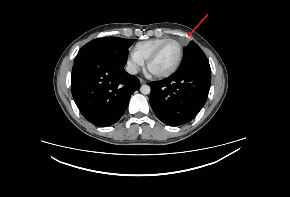 心膈角CT影像